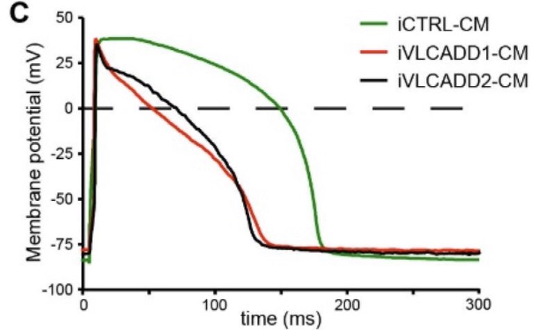 We collaborated with  @cbezzina1’s lab who can do very sophisticated electrophysiology on single cells. We found that iPS-CM from both patients had shorter action potentials. And they had rhythm disturbances called delayed afterdepolarizations (DADs)