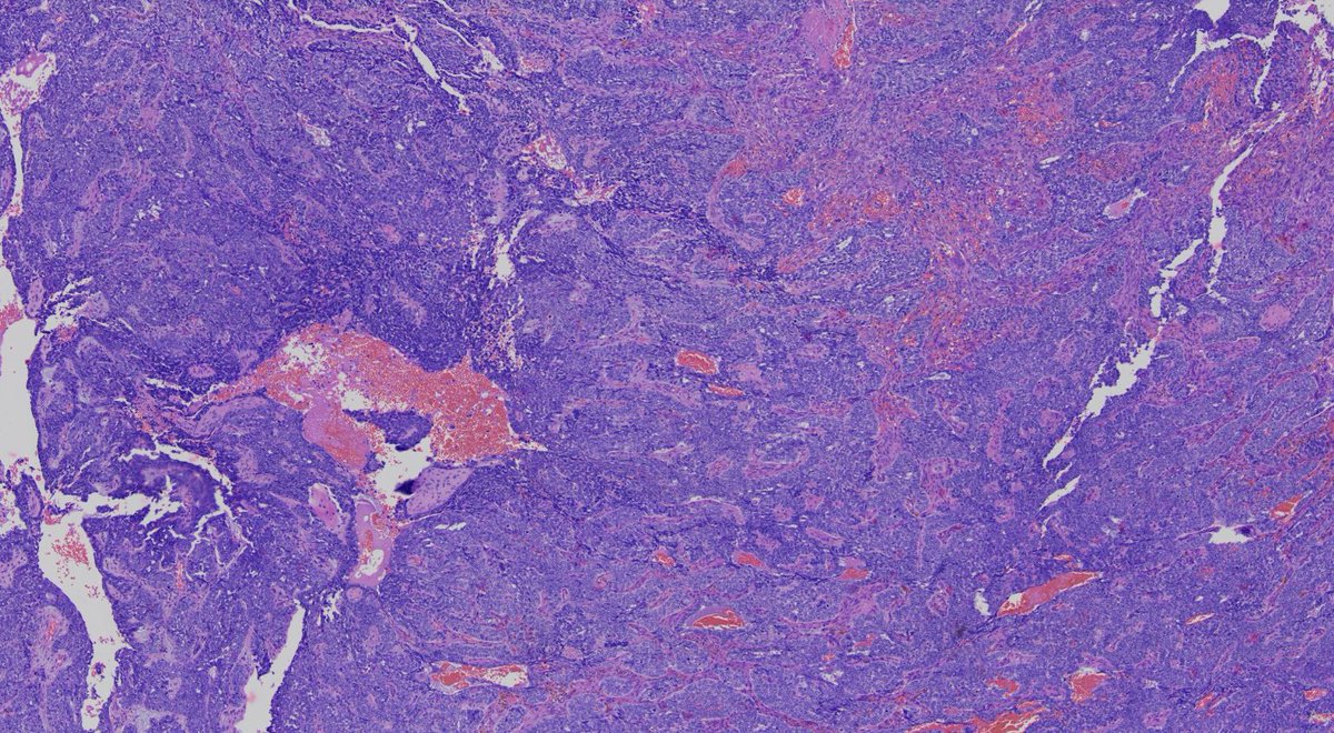 32/Mproximal tibia swellingx ray - eaten up proximal tibiafirst   #pathtweet   #BSTpath1/1