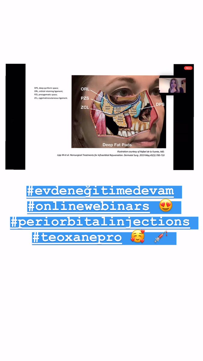isil1975's tweet photo. #onlinelivewebinars #evdendersçalışmayadevam #dermatolojikestetik #periorbitalanatomy #periorbitalfillers 
On line webinar’lar ile sıkılmaya vakit kalmıyor 😍🥰 https://t.co/OUKmC1SQ3S