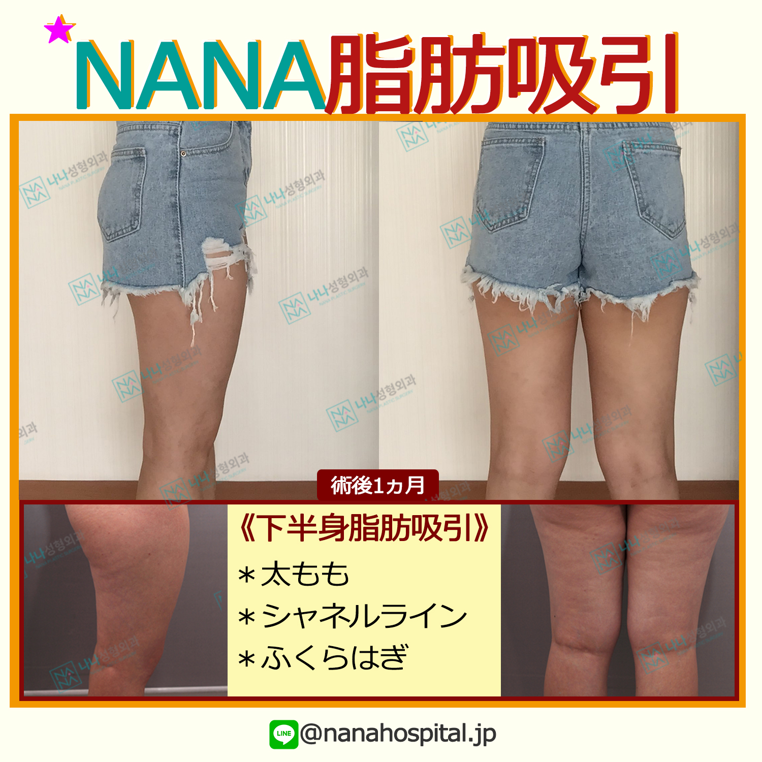 ট ইট র 江南bl 韓国政府認定 美容整形コンシェルジュ Nana美容外科 回復が早いミニ脂肪吸引 運動や食事制限では どうしても痩せれない局所部位の脂肪を吸引する脂肪吸引です 安全で効果的な手術として手術後 痣や痛みがほとんどないためすぐに日常