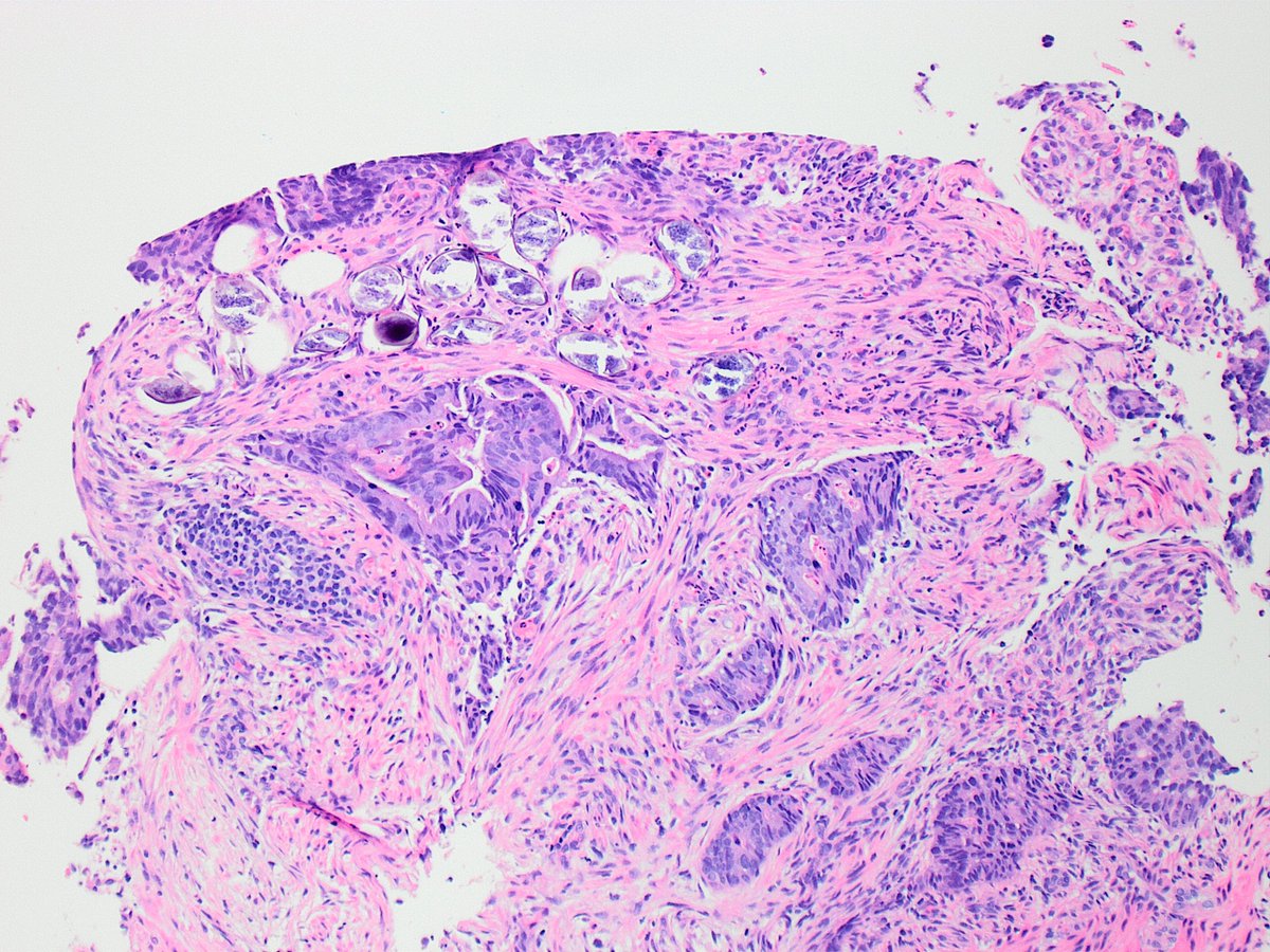 67 y/o female "sigmoid mass"🤔🔬
#pathology #GIpath