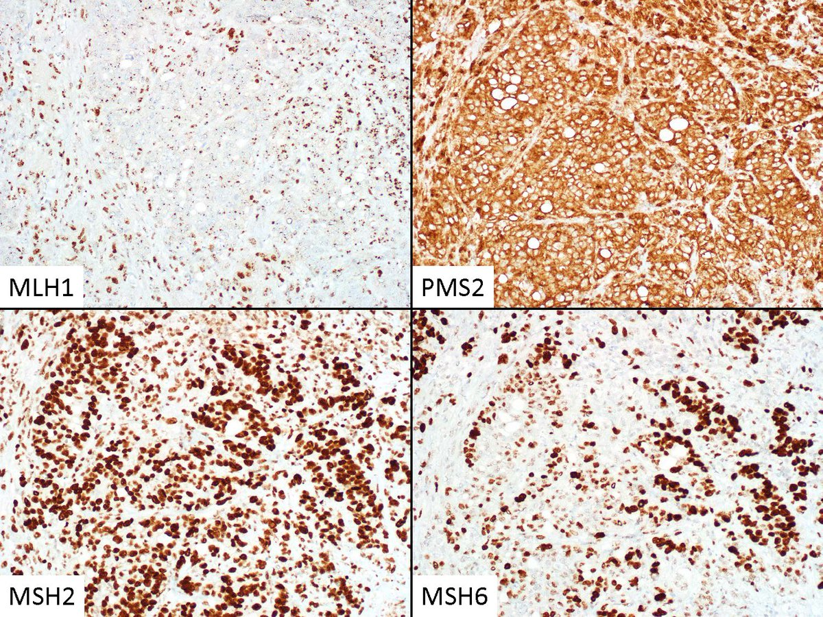 IHC_guy's tweet photo. Case of the Day: DNA MMR IHC on a recent consult . . . a colon cancer. How would you interpret the results of these stains and what's the next step in your workup???

#PathTwitter #CAPVirtualPath @UIPathology @ISIMMweb https://t.co/W5sOEo04Zt