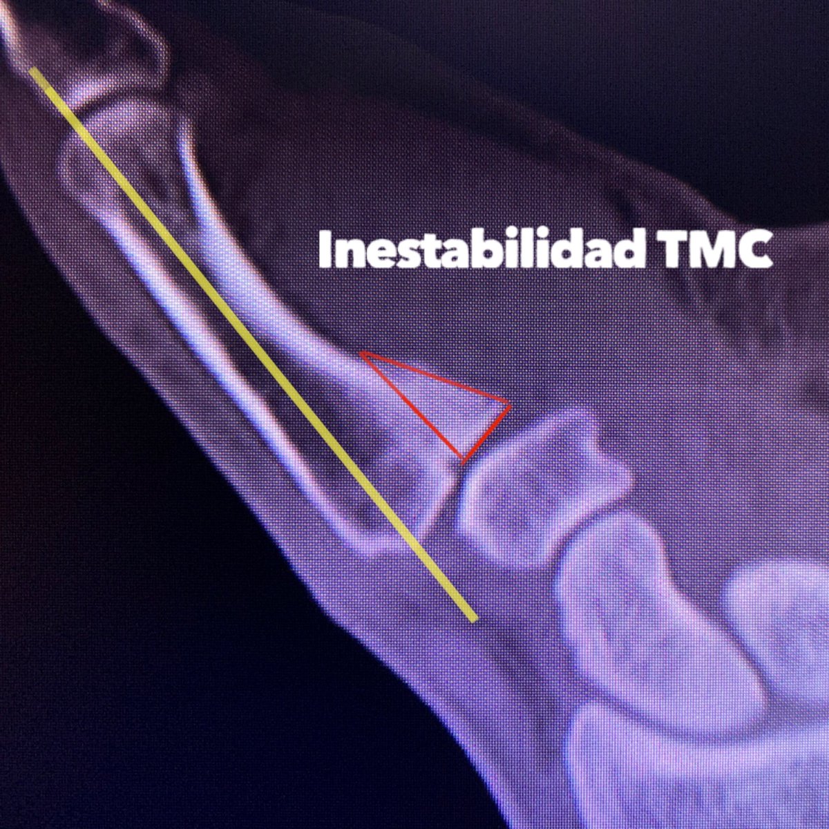 DrBarreraochoa's tweet photo. Seguimos con Fx de Bennett... ahora un caso clínico
▪️Secuelas de una Fx no tratada de 9 meses de evolución
▪️La fractura ha consolidado con un escalón intrarticular
▪️Inestabilidad dorsal asociada
▪️Se realizó osteotomia intrarticular➕ Estabilización mediante Sistema Microlink https://t.co/DNbyap2iFO