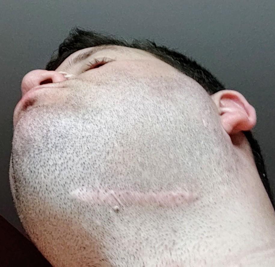 CH 9 - ReflectionI am feeling very exposed w/out my beard. I honestly don't feel like my usual confident self. But after a few beardless days I'm getting to know my face again. Noticing new moles, new scars, some old scars. Right now I'm fully exposed. Extra chin, scars n all.  https://twitter.com/TheHitterSports/status/1246942016149295105