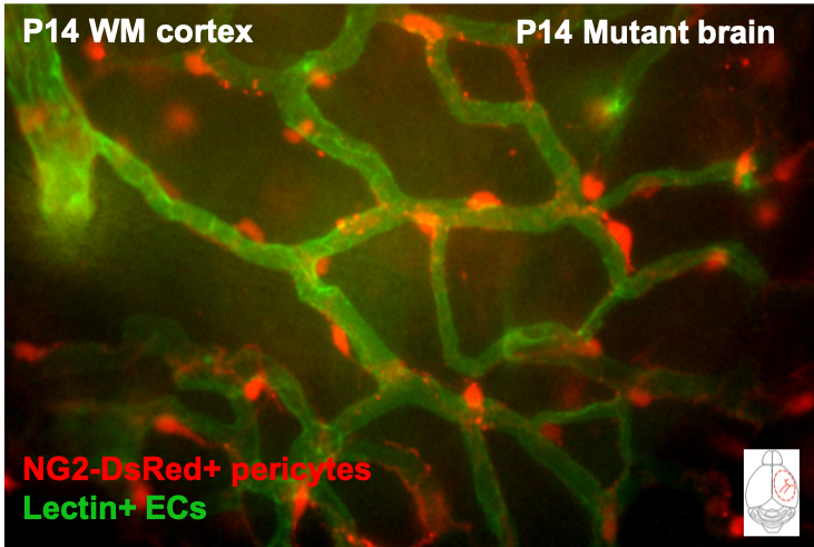 Mutations in the brain vascular endothelial cells can lead to brain arteriovenous malformations (bAVMs). I am working to determine effects to brain vascular pericytes during bAVM development and pathology. #OUVirtualExpo #OUSigmaXi @bobcatsdiscover <a href="/nielsen_ohio/">Nielsen Lab</a> <a href="/OhioBioSciences/">OU Biological Sciences</a>