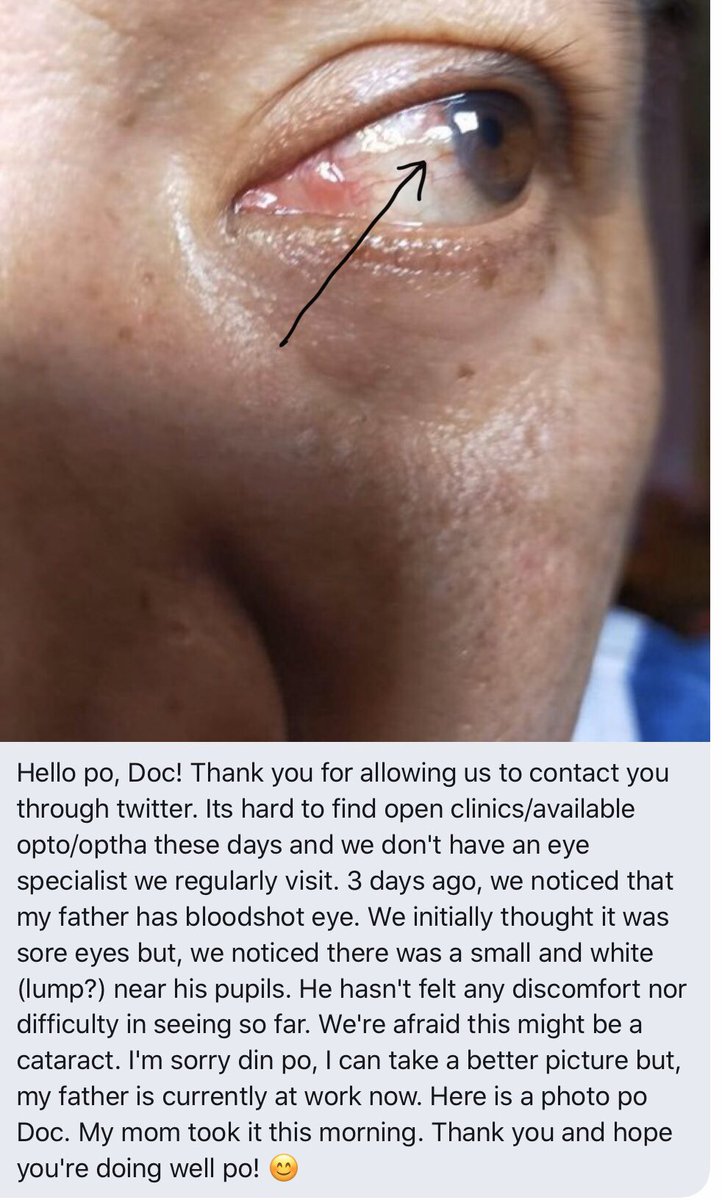 DrDrusenPH's tweet photo. Chief Complaint: “PUGITA” or “PUTING BUKOL sa Mata”
Diagnosis: Pinguecula and Pterygium
Management: Lubricants, Surgery
Meron din ba kayong ganitong problema? Relax, hindi po ito #Katarata
#Pterygium #Pinguecula https://t.co/2EV7iBuz0H