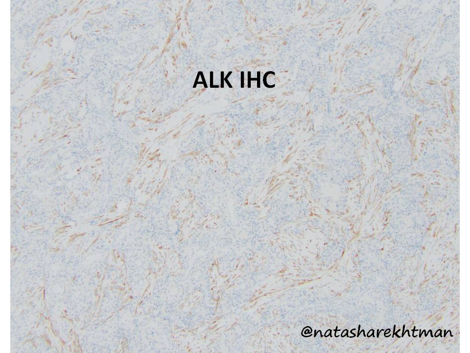 1 Great job everyone! Here is the diagnostic stain: ALK. So this is indeed an inflammatory myofibroblastic tumor (IMT). So lets discuss DDx and a few updates about IMTs.