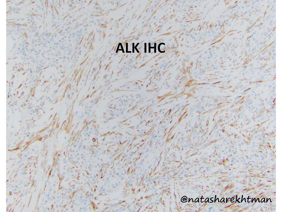 1 Great job everyone! Here is the diagnostic stain: ALK. So this is indeed an inflammatory myofibroblastic tumor (IMT). So lets discuss DDx and a few updates about IMTs.