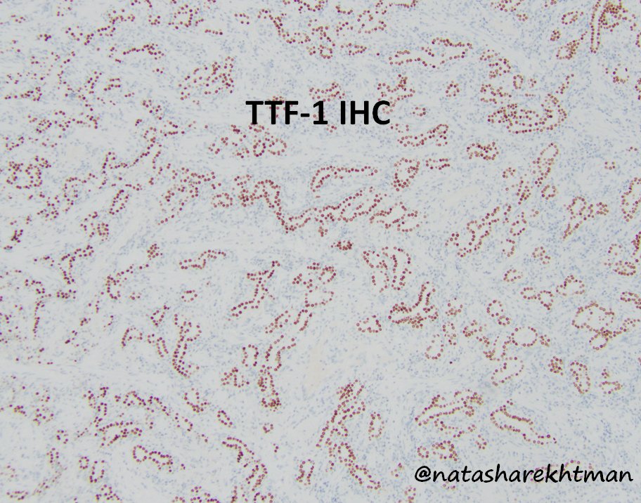 9 Lastly, what about all this epithelial stuff? Here it is highlighted by TTF-1. These are entrapped alveolar structures lined by hyperplastic pneumocytes. When present in the midst of scars, inflammatory lesions, other tumors - they can easily lead you astray. Do not let them!