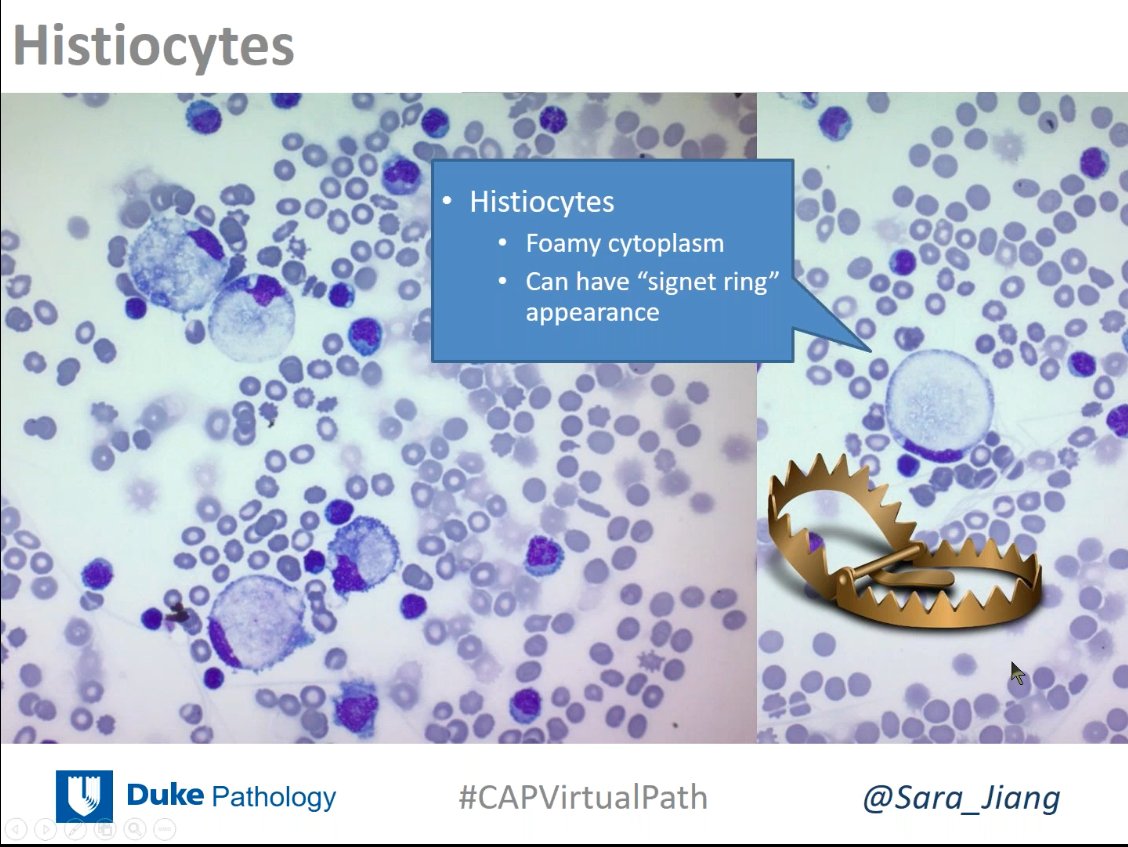 ALBoothMD's tweet image. Don't get fooled by reactive mesothelial cells and histiocytes! @Sara_Jiang #cytopath #CAPVirtualPath