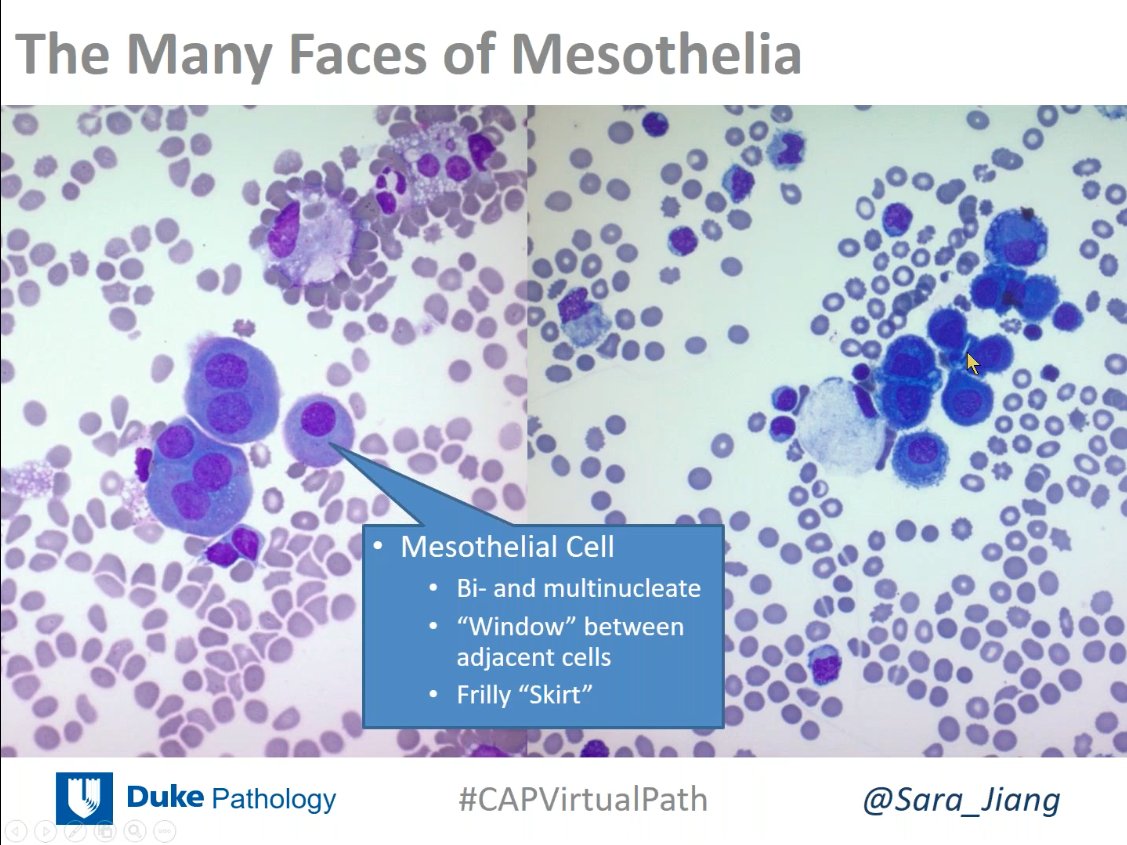 ALBoothMD's tweet image. Don't get fooled by reactive mesothelial cells and histiocytes! @Sara_Jiang #cytopath #CAPVirtualPath