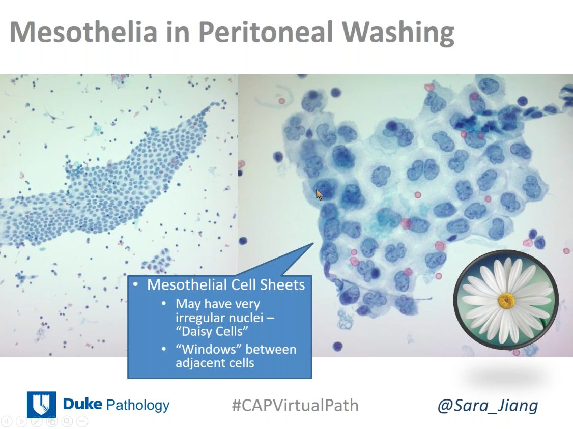 ALBoothMD's tweet image. Don't get fooled by reactive mesothelial cells and histiocytes! @Sara_Jiang #cytopath #CAPVirtualPath