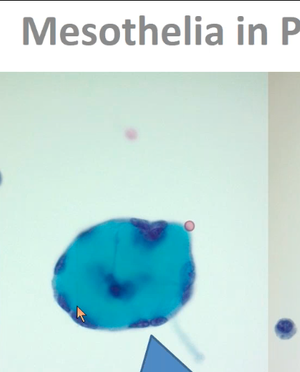 ALBoothMD's tweet image. Don't get fooled by reactive mesothelial cells and histiocytes! @Sara_Jiang #cytopath #CAPVirtualPath