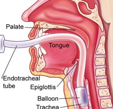 Remember, airflow is like current in a circuit, it flows where there is minimum resistance. So the ET along with a balloon-like (plus some fluid sensors) is placed inside the windpipe and blown to seal the windpipe, otherwise you'll just be ventilating the hospital.