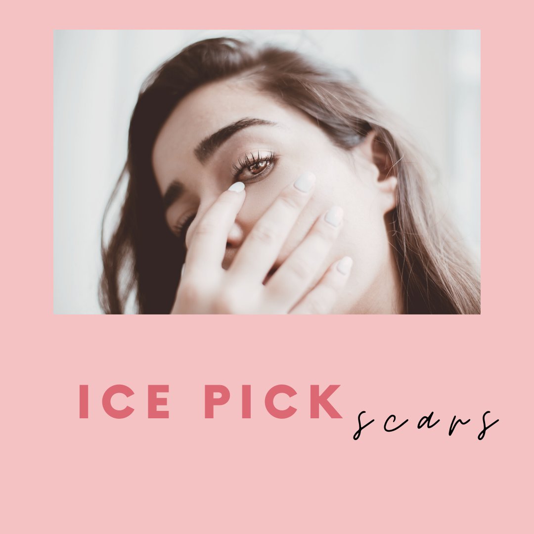 Ice pick scars are deep and narrow scars that occur into the dermis region of the skin. From above, the skin will look as if it has been pierced by an ice pick or a sharp object. These scars form a small, thin, deep hole into the skin and may look like an open pore.