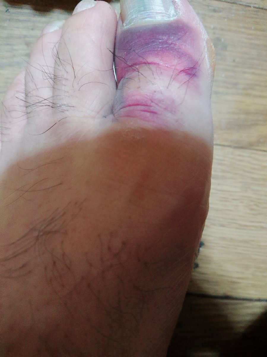 足の指載せるん恥ずかしいけど私の親指可愛そうなすぎて載せてしまった🤣w

緊急外来行ったら『折れてますね」て😳w

てか足の毛はスルーちて🙇‍♀️笑