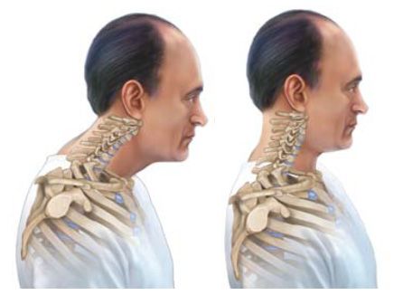 danielcruzelife's tweet photo. If your neck is like the guy's on the left

It's called forward head (or nerd neck)

It makes you look weak and submissive

Fix that shit ASAP.

- Chin tucks
- Neck and back stretches
- Strengthen upper back and shoulders
- Stretch your chest
- Get a better chair and pillow https://t.co/yWzeLbnkAI
