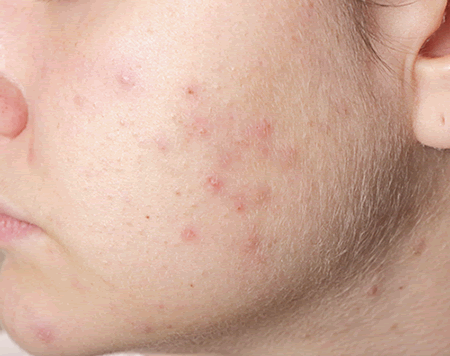 Acne scars is discoloration or hyperpigmentation and the aftermath of pimples. Acne scars ada 3 jenis. First one is post inflammatory hyperpigmentation dikenali sebagai (PIH), second is post inflammatory erethyma dikenali sebagai (PIE) and last but not least is atrophic scarring