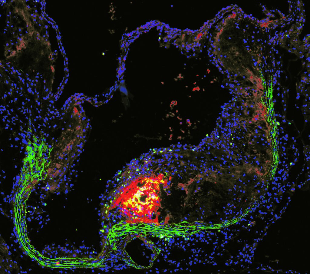 JCI_insight's tweet photo. On this issue's cover: The NET effect on macrophages in atherosclerosis https://t.co/esnFAYSKeA @NYUCVDPrevent @NYUCVRC

Atherosclerotic plaques appear in the vicinity of NETs (colocalization of MPO (red), H3Cit (pink), and Ly6G (green)) in an area also positive for macrophages. https://t.co/k8NvE8zNU1