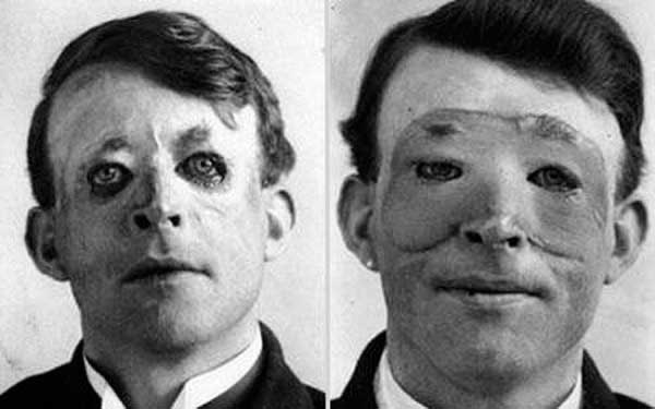 6 - Walter Yeo, uma das primeiras pessoas a passar por um transplante de pele e cirurgia plástica avançada em 1917.