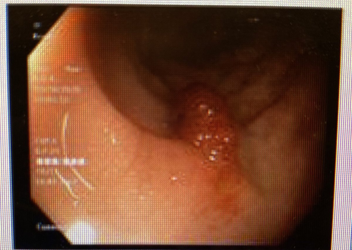 fahedjulien's tweet photo. An incidental finding of a tubular adenoma on #colonoscopy in an 18 year old patient. I have seen it in patients in their 20s, but at 18, that is a first to me. #GI #everyday #endoscopy #gastroenterology #medicine #medical https://t.co/ZxpS8g2dbM