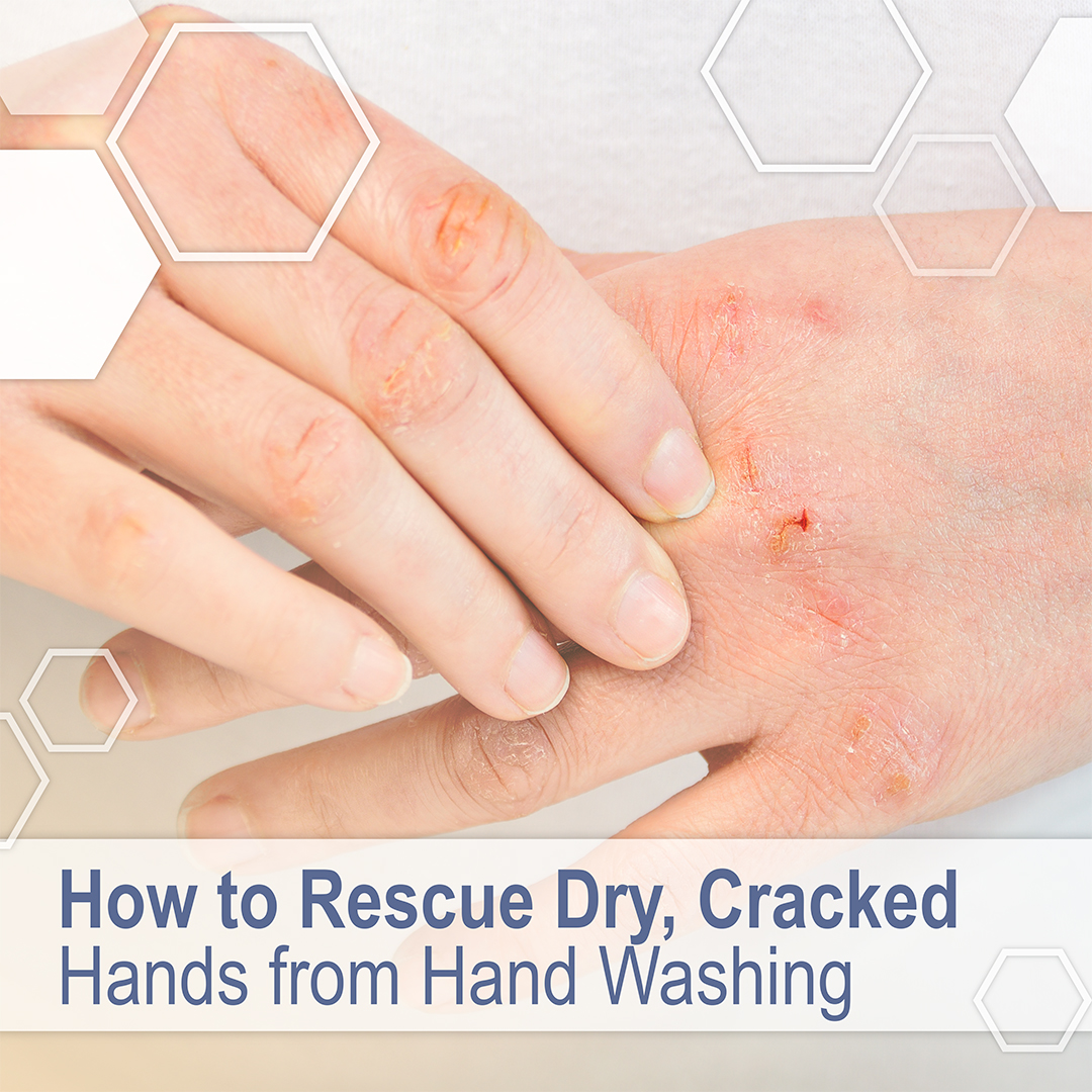 apdermcares's tweet photo. With the increased frequency of hand washing to prevent the spread of coronavirus, our hands are taking a beating! Our own Dr. Joyce offers solutions to rescue your dry, cracked hands. Learn more https://t.co/vpWdL4MfST #apderm #dermatology https://t.co/B41cxYEtOg