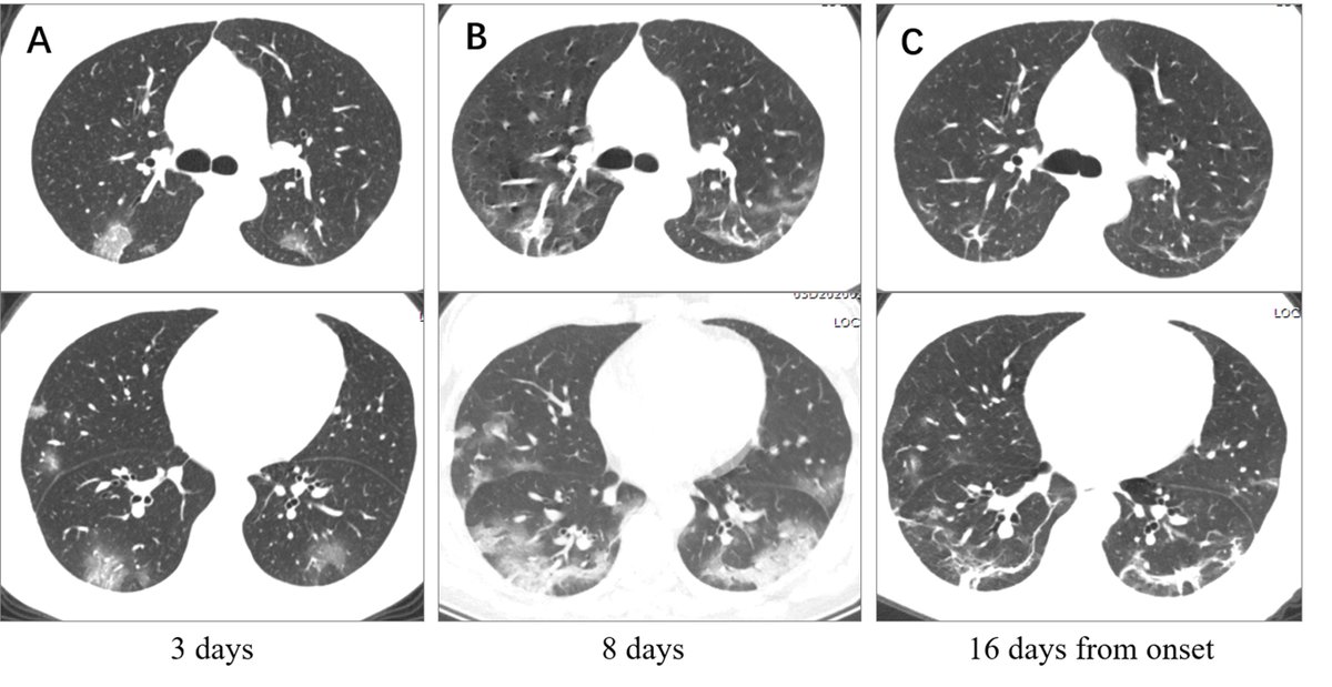 2. Basal lung = where perfusion is greatestPeripheral lung = where capillary networks are richest.Immune complexes most readily deposit within the interstitium of capillaries --> lymphohistiocytic response....this potentially explains the predominant CT findings in COVID-19.