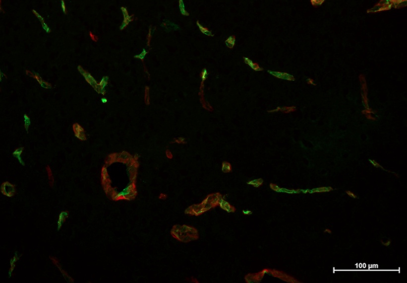 Julia LaComb #OUVirtualExpo @bobcatsdiscover
I am studying the expression of pericytes in association with endothelial cells in regards to arteriovenous malformation (AVM) in mammals. My focus is N-Cadherin, a protein required to maintain association between the two cell types.
