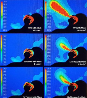 GAPlotnikow's tweet photo. ⚠️🚨#NerdAttack 🤓
CNAF con barbijo por arriba. Estudio con #ModeloExperimental
👍 Informa datos de de alta demanda ventilatoria (FR elevada y alto Vt) y boca abierta (según la imagen)
👎 El 16% de las partículas que se escaparon con alto flujo viajan a 1m ⚠️
(4/7) https://t.co/hFEFuigv0G