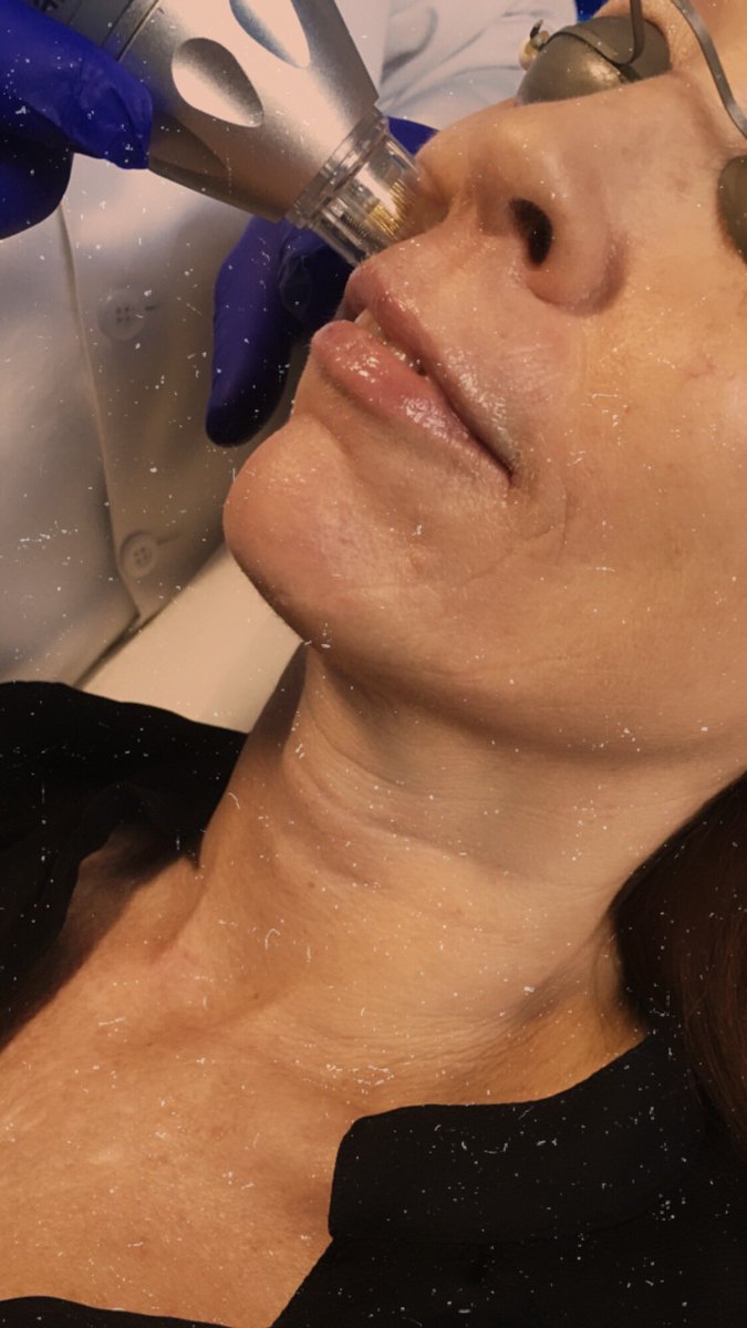 WymoreLaser's tweet photo. RF Microneedling to tighten skin and reduce wrinkles #orlandofl #winterparkfl #microneedling #wymorelaser https://t.co/rPaxbJO2Sv