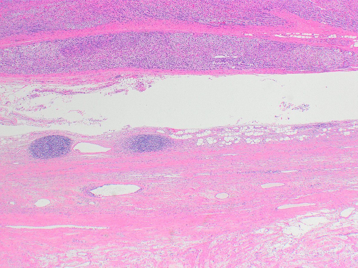 Kiril_T_Can's tweet image. Received as "left adrenal and tumor". First photo, "adrenal" (top), "tumor" (bottom). Remaining photos are from the tumor (11 cm greatest dimension, grew over several years). 
🤔🔬