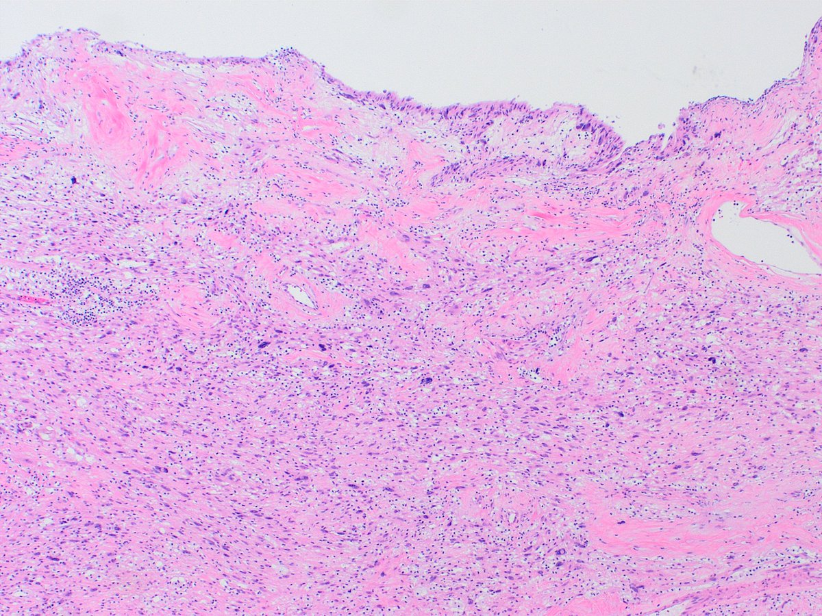 Kiril_T_Can's tweet image. Received as "left adrenal and tumor". First photo, "adrenal" (top), "tumor" (bottom). Remaining photos are from the tumor (11 cm greatest dimension, grew over several years). 
🤔🔬