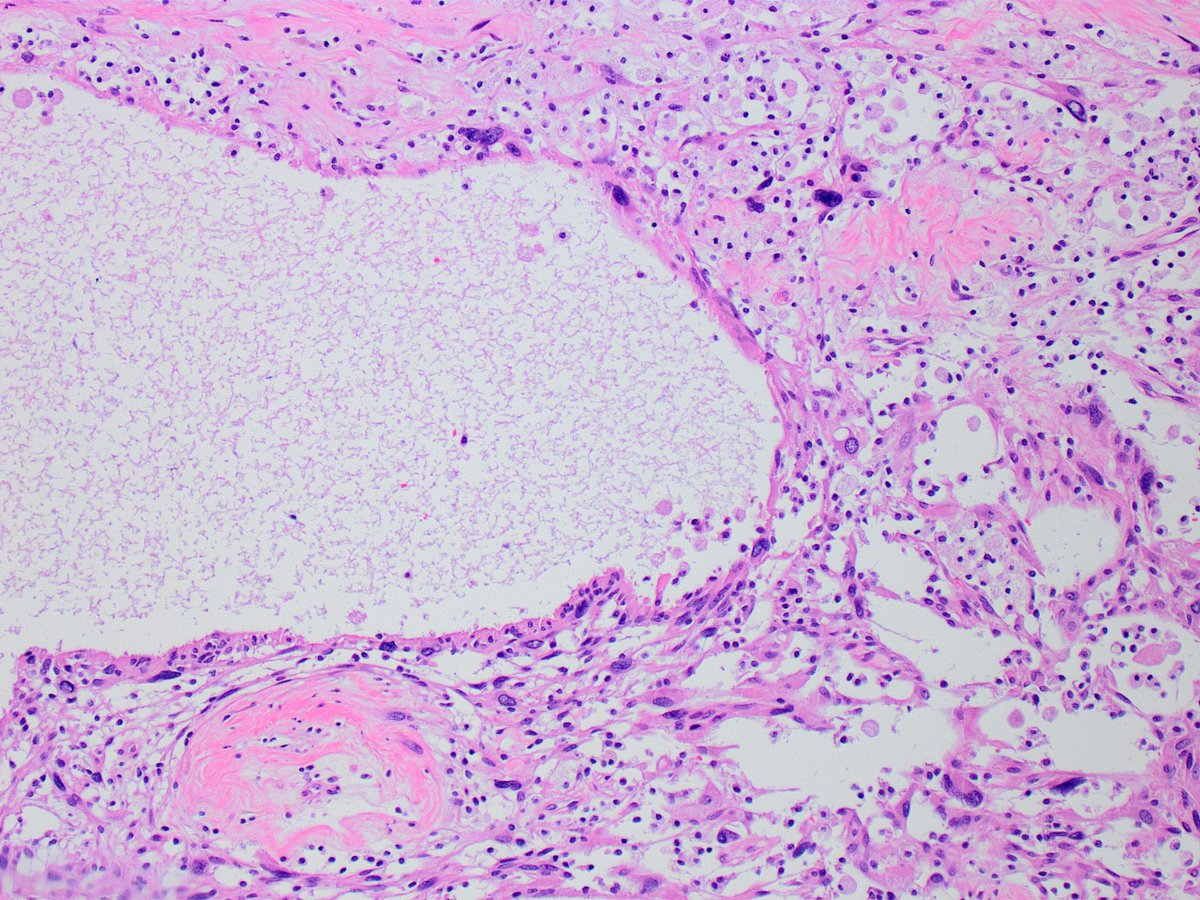 Kiril_T_Can's tweet image. Received as "left adrenal and tumor". First photo, "adrenal" (top), "tumor" (bottom). Remaining photos are from the tumor (11 cm greatest dimension, grew over several years). 
🤔🔬