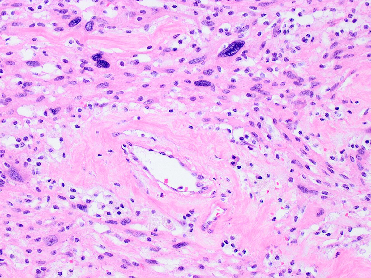 Kiril_T_Can's tweet image. Received as "left adrenal and tumor". First photo, "adrenal" (top), "tumor" (bottom). Remaining photos are from the tumor (11 cm greatest dimension, grew over several years). 
🤔🔬