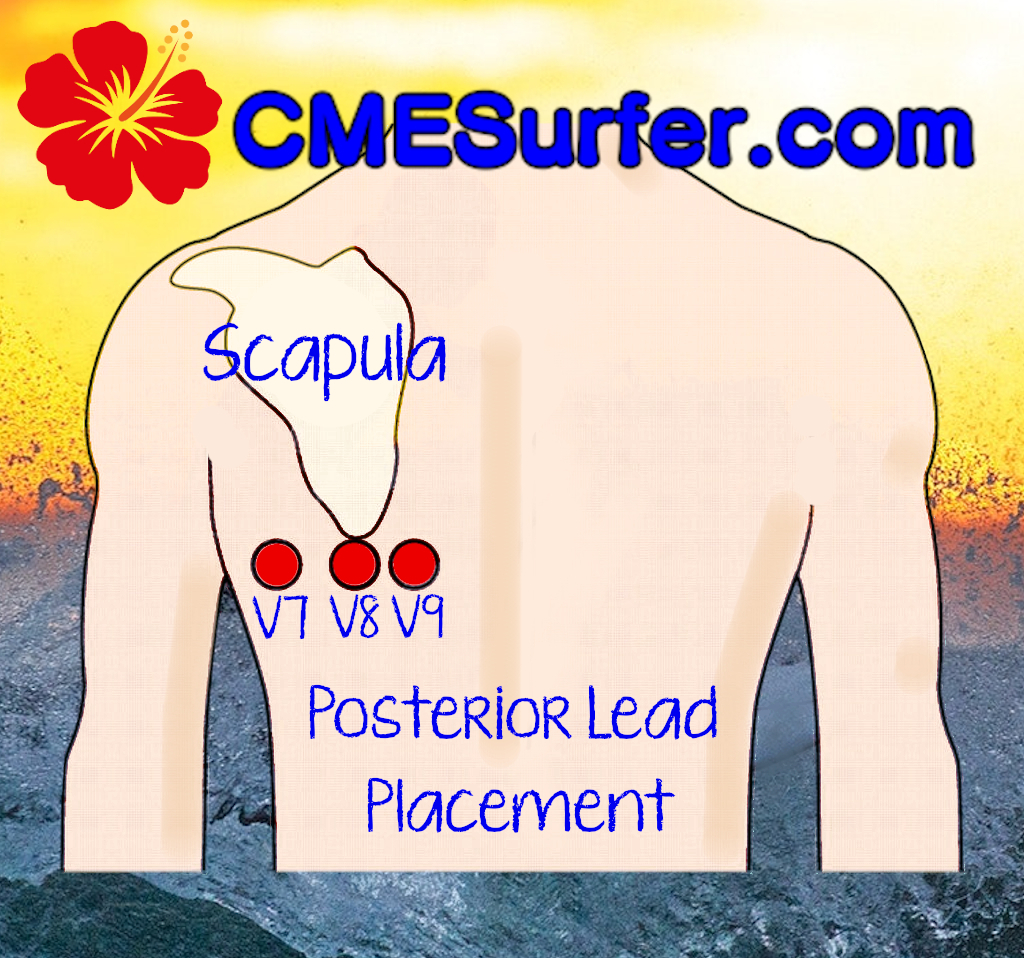 SurferCme's tweet photo. We don't use these often so this is a handy graphic to save to your phone! ⁠
Sign up at https://t.co/9wdq29foDT for effective, fast and fun medical education.⁠
#12leadecg,#12leadekg,#12leadinterpretation,#posteriorleads,#flightnurse,#flightparamedic,#medschoolecg https://t.co/TZeZCy802K