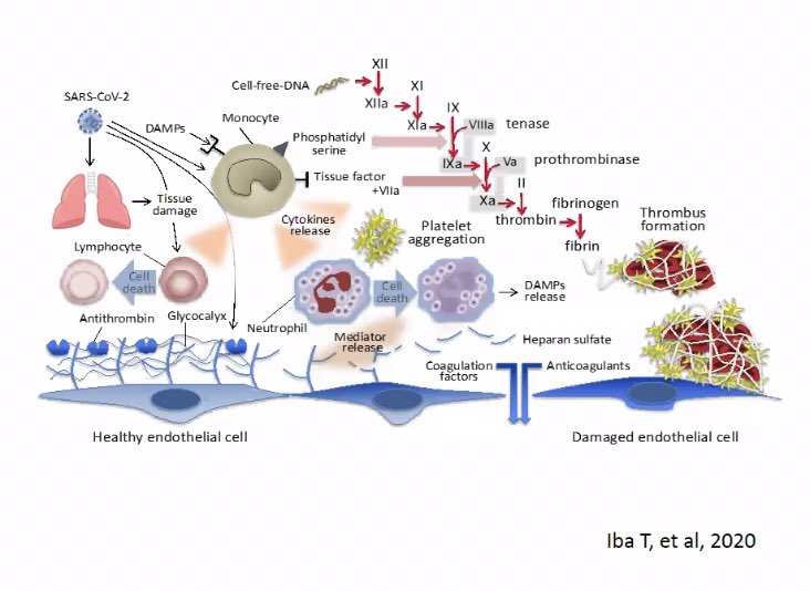 Dr Maryam Khosravi (@piezoelectricky) on Twitter photo Coagulopathy in COVID <a href="/isth/">ISTH</a> webinar <a href="/MarcelLevi/">Marcel levi</a> and <a href="/bhwords/">Professor Beverley Hunt OBE (also on BlueSky)</a>
My take home messages:
- inflammation correlates with coagulopathy
-> inflammation & coagulopathy correlate with survival
Looks a bit like DIC & microangiopathy, but DOESN’T reach DIC diagnostic criteria <a href="/isth/">ISTH</a> Coagulopathy in COVID <a href="/isth/">ISTH</a> webinar <a href="/MarcelLevi/">Marcel levi</a> and <a href="/bhwords/">Professor Beverley Hunt OBE (also on BlueSky)</a>
My take home messages:
- inflammation correlates with coagulopathy
-> inflammation & coagulopathy correlate with survival
Looks a bit like DIC & microangiopathy, but DOESN’T reach DIC diagnostic criteria <a href="/isth/">ISTH</a>