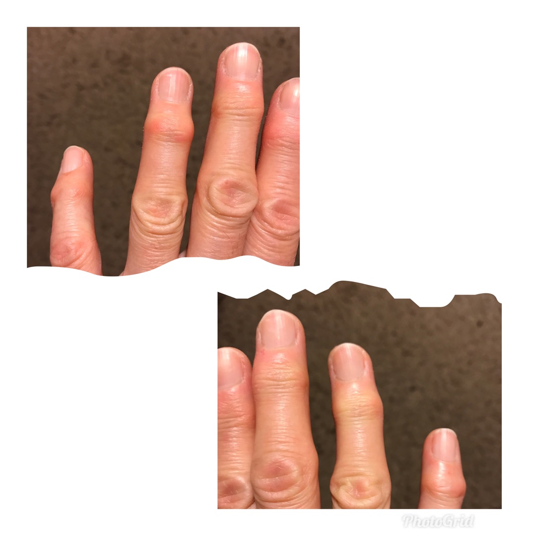 ヘパーデン結節