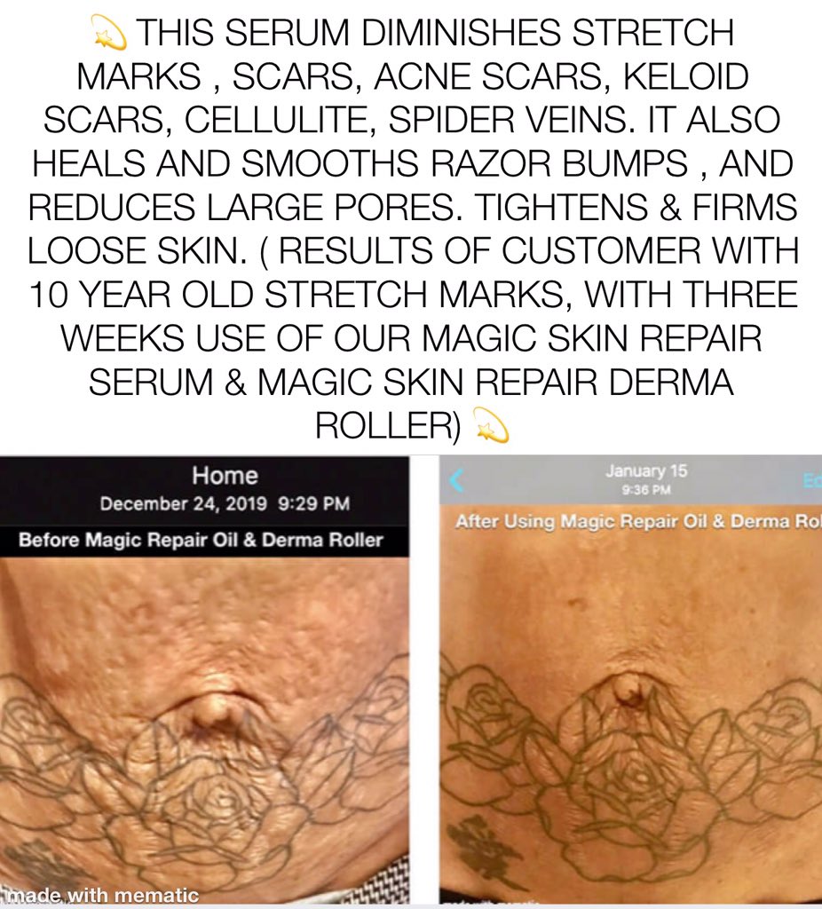 MagicSkinRepai2's tweet photo. Real results! https://t.co/mo4NEyHrIx stretchmarks #skincare #organicskincare #skincareroutine #beauty #natural #naturalbeauty #healthyskin #organic #scarface #glowingskin #antiaging #skin #selfcare #cleanbeauty #skincareproducts  #skincaretips #naturalproducts #organicbeauty https://t.co/JtKMOoGQVF