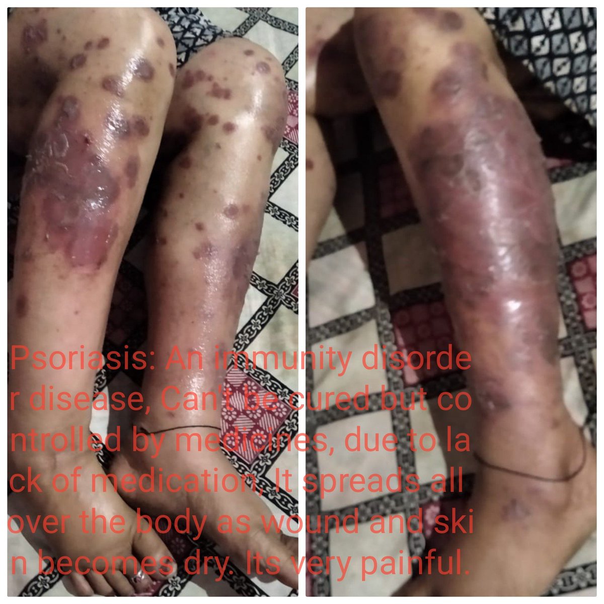 skrprasad's tweet photo. Hi @NetMeds  my order Id:15847217039022590ASO1 and Delhivery tracking id: 1252039378370 is not yet delivered. Kindly arrange to deliver it urgently, we live in a small village, these medicines are not available here.#essentialservices @NitishKumar @PMOIndia https://t.co/VFJ3kl8yFe