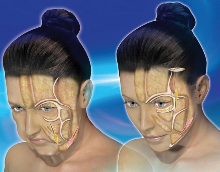 Plastic and Reconstructive Surgery on Twitter "What is mirror facelift