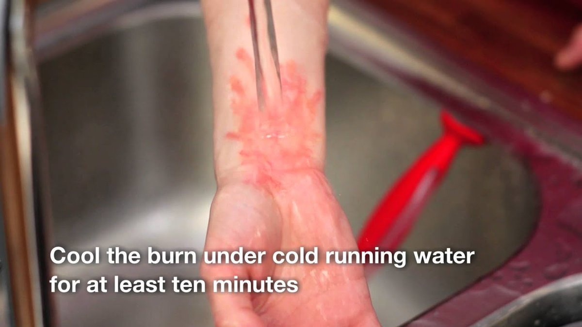 Guyur area luka bakar segera dengan air mengalir selama 10-20 menit atau ketika rasa panas yang di area luka bakar mulai menghilang. Upaya ini bertujuan untuk menetralkan suhu permukaan sehingga perluasan luka bakar dapat dihambat