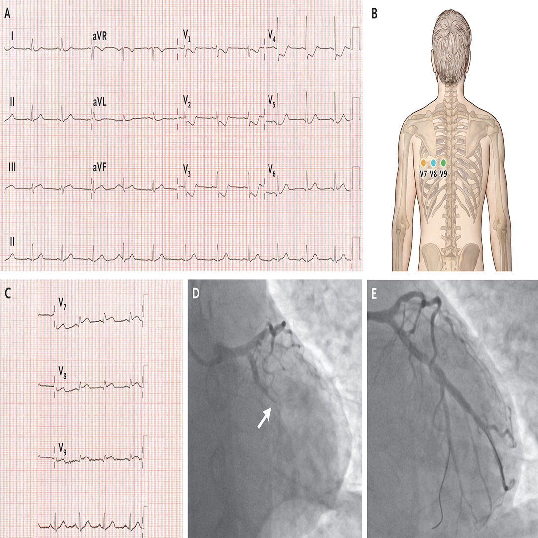 UTHSCPAprogram's tweet image. Answer: ST depression in V1-V4 with a (+) terminal T-wave and large R-wave in V2 and V3, suggestive of posterior AMI.

Perform posterior leads V7-V9

#MondaysWithMaday #PAProfPearls #questionoftheday #PAschool  #physicianassistantstudent

nejm.org/doi/full/10.10…