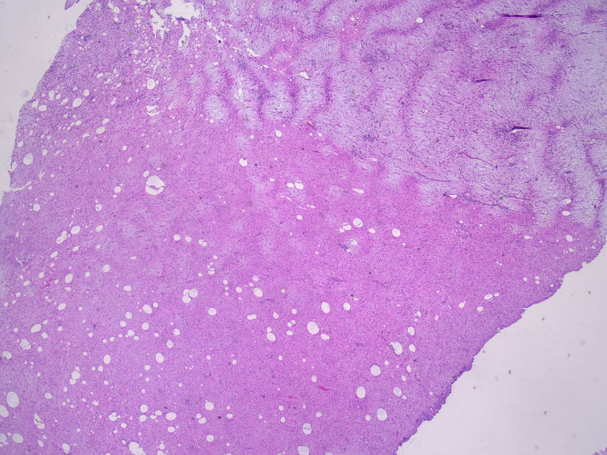 Teclis82's tweet photo. Case I very nearly eff’ed up: 42 year old man, 3.5cm mass apparently arising from the gastric serosa.  Will post some IHCs in a bit.
#GIpath #BSTpath @IHC_guy @JMGardnerMD @TxicMegacolon @LizMontgomeryMD @CArnold_GI https://t.co/0KFHRgX5bq