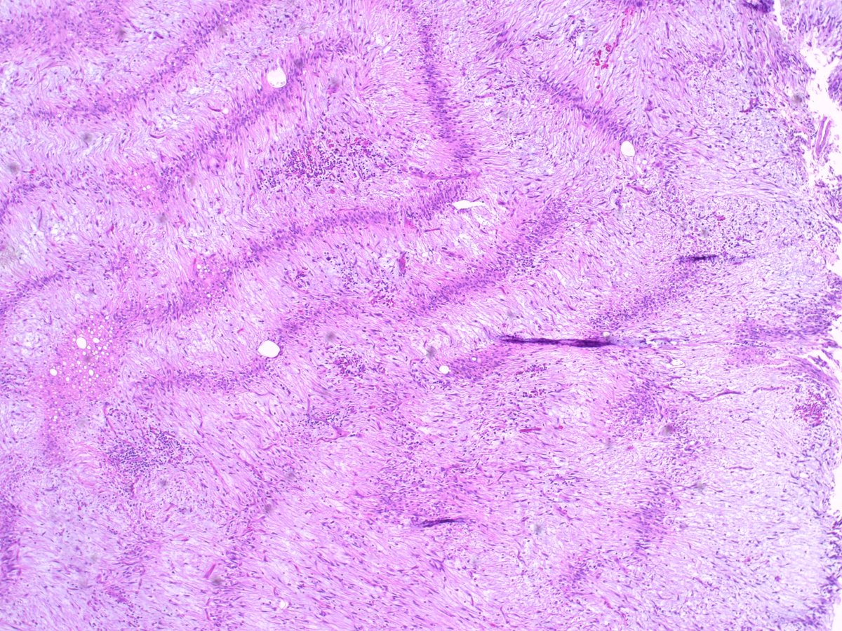 Teclis82's tweet photo. Case I very nearly eff’ed up: 42 year old man, 3.5cm mass apparently arising from the gastric serosa.  Will post some IHCs in a bit.
#GIpath #BSTpath @IHC_guy @JMGardnerMD @TxicMegacolon @LizMontgomeryMD @CArnold_GI https://t.co/0KFHRgX5bq