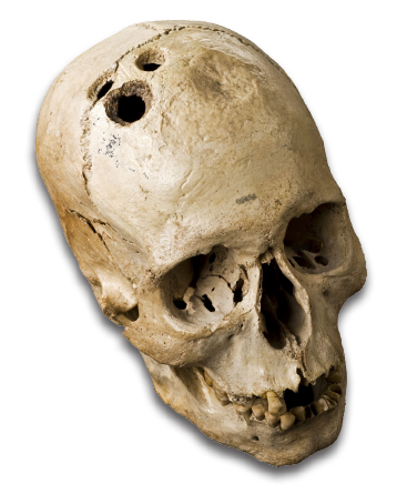 Madness is ancient. Around 10% of all the stone-age skulls unearthed have holes, intentionally, bored into them. One theory is that this procedure was a treatment for, among other things, mental health problems.