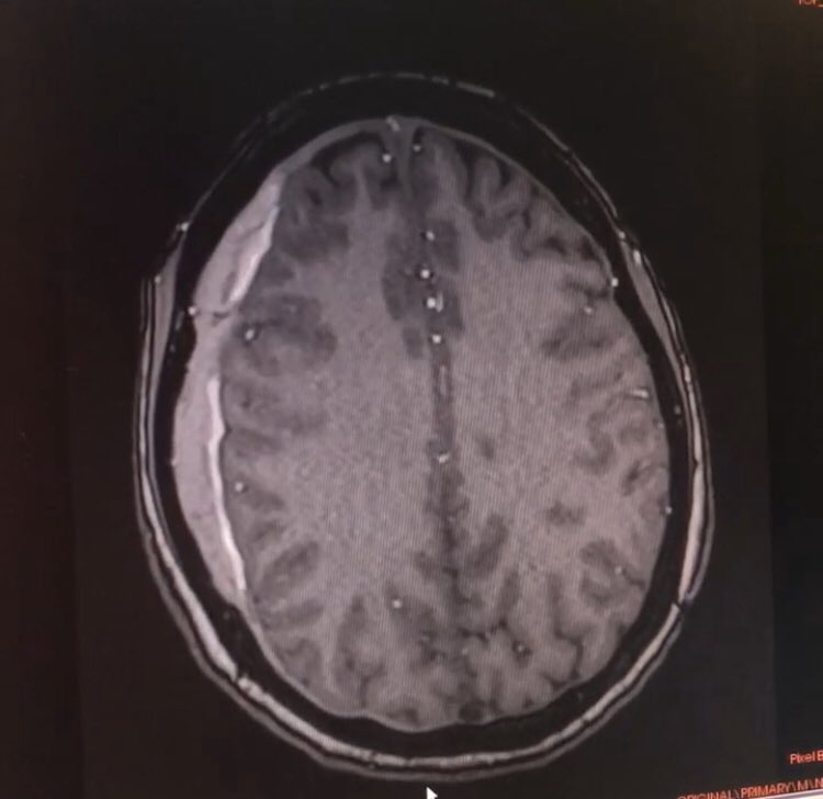 Drdimple5's tweet photo. @PeterGKranz I absolutely agree that ‘WHY’ is a very important question.  When doctors said me you were having subdural hemorrhage. I asked the answer of this question for 20 days. WHY? Why did I have a subdural hemorrhage at 32 years old ? Finally the answer was found . SIH . https://t.co/xnNCRKw9bZ