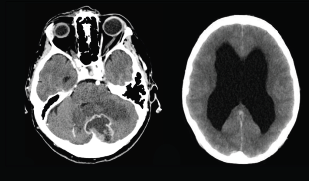 14. Call Radiology! An *urgent* CT head → The results of the CT head are shown below. What do you notice?   #BBHCP