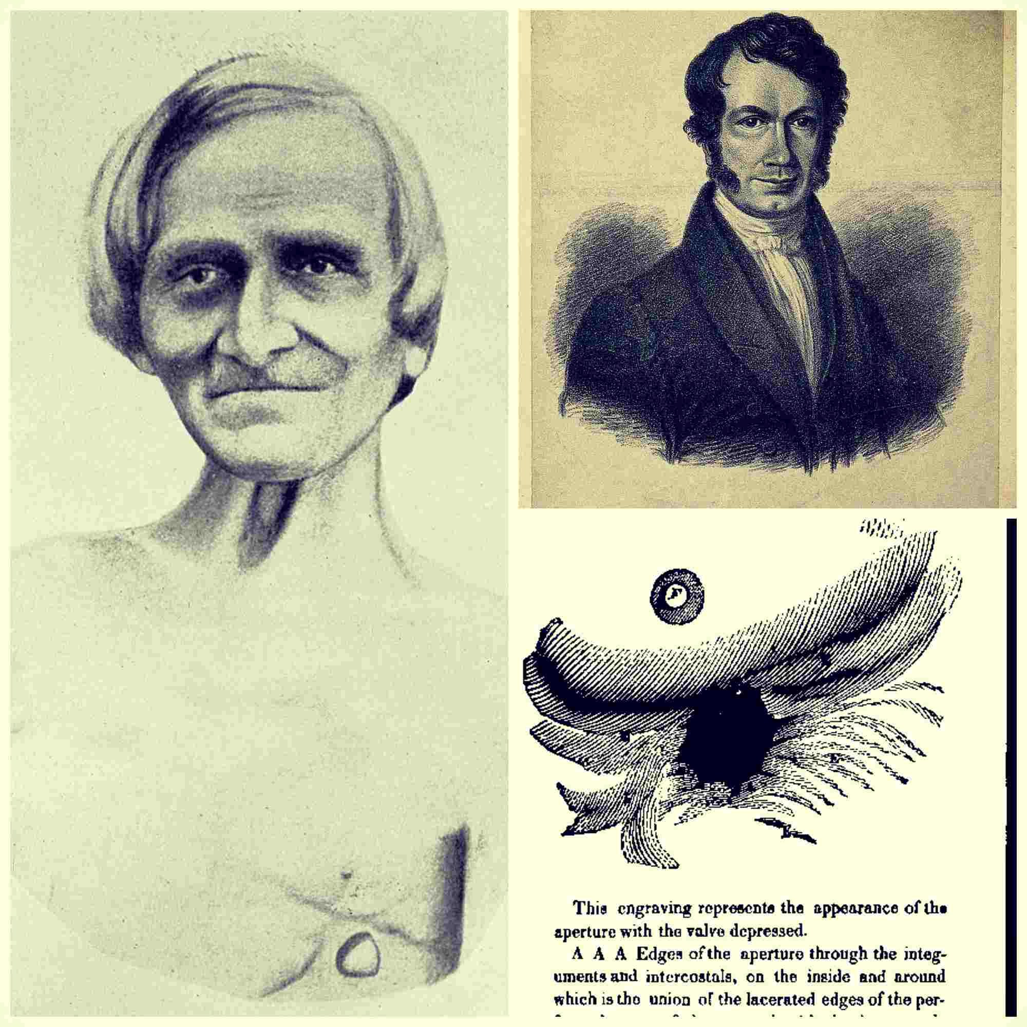 Catéter Doble Jota on Twitter: "👨🏼‍🤝‍👨🏻 La pareja más rara de la medicina: el Dr. William Beaumont y su “cobaya humana” Alexis St. Martin 🧪 Los experimentos que nos permitieron saber como