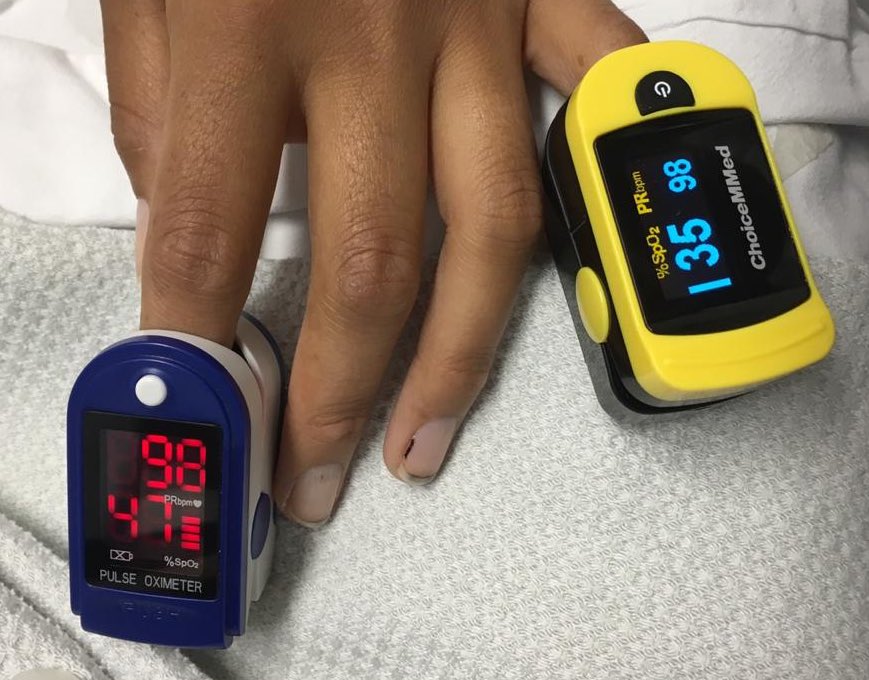 Case of mine: Young patient, O2sat <50% room air; 80% on 15 L NRM. Completely normal mental status, no shortness of breath, no increased WOB, no tachypnea. Pt feeling ok and looked happy. (1/4)