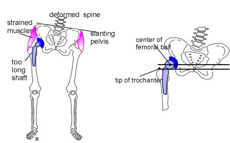 A thread on leg length discrepancies and how they affect performanceThis is very common. Several studies show this is exists in >90% of people (Korpelainen et. al, 2001, Lawrence, 1984).It’s often a compensatory orientation that is driven by asymmetries getting out..(1/6)